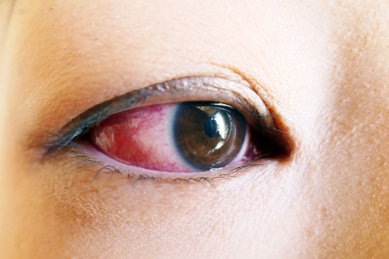 痛い 目尻 早く眼科を受診した方がいい充血とは？