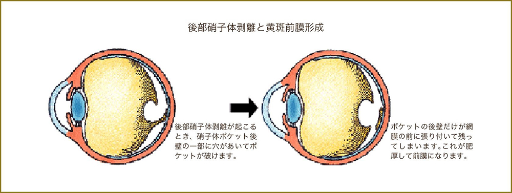 黄斑前膜手術 船橋市 なつみだい眼科 船橋 新船橋 塚田